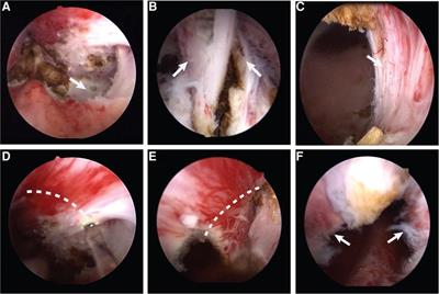 Pretreatment of the urethral mucosa at the tip of the prostate: a retrospective review in preventing stress urinary incontinence after thulium laser enucleation of the prostate